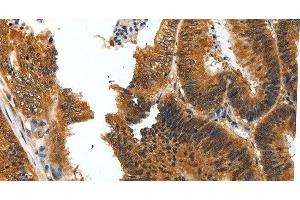 Immunohistochemistry of paraffin-embedded Human colon cancer tissue using BIRC6 Polyclonal Antibody at dilution 1:30 (BIRC6 抗体)