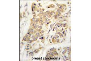 Formalin-fixed and paraffin-embedded human breast carcinoma tissue reacted with CDH8 antibody , which was peroxidase-conjugated to the secondary antibody, followed by DAB staining. (Cadherin 8 抗体  (N-Term))