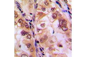 Immunohistochemical analysis of Histone Deacetylase 8 (pS39) staining in human lung cancer formalin fixed paraffin embedded tissue section. (HDAC8 抗体  (N-Term, pSer39))