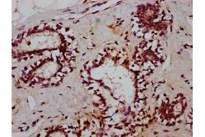 IHC image of ABIN7172427 diluted at 1:600 and staining in paraffin-embedded human breast cancer performed on a Leica BondTM system. (TCEA3 抗体  (AA 79-169))