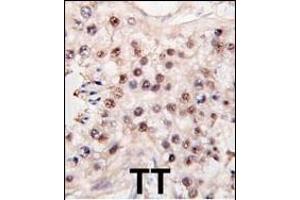 Formalin-fixed and paraffin-embedded human testicle tumor tissue reacted with HDAC11 antibody (C-term) (ABIN387965 and ABIN2844703) , which was peroxidase-conjugated to the secondary antibody, followed by DAB staining. (HDAC11 抗体  (C-Term))