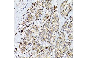 Immunohistochemistry of paraffin-embedded human breast cancer using PSAP Rabbit pAb (ABIN3022605, ABIN3022606, ABIN3022607, ABIN1513432 and ABIN6218938) at dilution of 1:50 (40x lens). (Prosaposin 抗体  (AA 60-310))