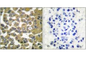 Immunohistochemistry analysis of paraffin-embedded human breast carcinoma tissue, using MMP-11 Antibody. (MMP11 抗体  (AA 61-110))