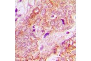 Immunohistochemical analysis of UBE3B staining in human breast cancer formalin fixed paraffin embedded tissue section.