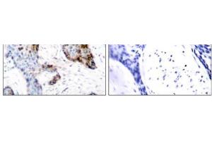 Immunohistochemical analysis of paraffin-embedded human breast carcinoma tissue using Estrogen Receptor-α (Ab-118) antibody (E021067). (Estrogen Receptor alpha 抗体)