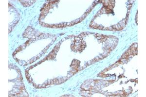 Formalin-fixed, paraffin-embedded human Prostate Carcinoma stained with CD47 Mouse Monoclonal Antibody (IAP/2937).