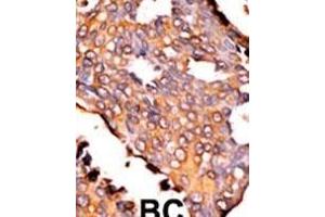 Formalin-fixed and paraffin-embedded human cancer tissue reacted with the primary antibody, which was peroxidase-conjugated to the secondary antibody, followed by AEC staining. (Riboflavin Kinase 抗体  (N-Term))