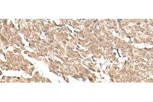 Immunohistochemistry of paraffin-embedded Human lung cancer tissue using KDM2A Polyclonal Antibody at dilution of 1:55(x200) (KDM2A 抗体)