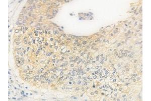 ABIN6262683 and ABIN6278907 at 1/100 staining human cervical carcinoma by IHC-P. (ITGA8 抗体  (C-Term))