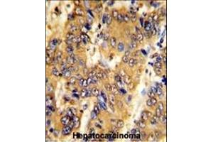 Formalin-fixed and paraffin-embedded human hepatocarcinoma with MSRB2 Antibody (Center), which was peroxidase-conjugated to the secondary antibody, followed by DAB staining. (MSRB2 抗体  (AA 44-73))