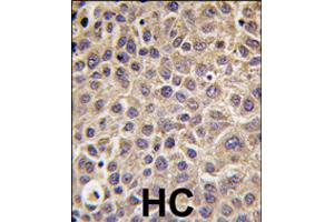 Immunohistochemistry (Formalin/PFA-fixed paraffin-embedded sections) of human hepatocellular carcinoma with MTMR9 polyclonal antibody , followed by peroxidase-conjugated secondary antibody and DAB staining. (MTMR9 抗体  (C-Term))