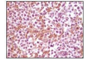 Immunohistochemical analysis of paraffin-embedded human glioma tissue, showing membrane localization using SNCA mouse mAb with DAB staining. (SNCA 抗体)