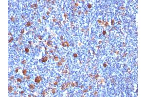 Formalin-fixed, paraffin-embedded human Hodgkin's Lymph stained with Fascin-1 Mouse Monoclonal Antibody (SPM133) (Fascin 抗体)