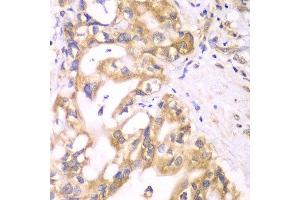 Immunohistochemistry of paraffin-embedded human liver cancer using ACADS antibody at dilution of 1:100 (x40 lens). (ACADS 抗体)