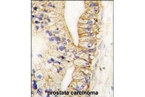 Formalin-fixed and paraffin-embedded human prostata carcinoma tissue reacted with CDH7 antibody , which was peroxidase-conjugated to the secondary antibody, followed by DAB staining. (Cadherin 7 抗体  (N-Term))