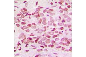 Immunohistochemical analysis of NF-kappaB p100 (pS865) staining in human breast cancer formalin fixed paraffin embedded tissue section. (NFKB2 抗体  (C-Term, pSer865))