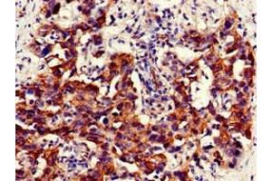 Immunohistochemistry of paraffin-embedded human bladder cancer using ABIN7161574 at dilution of 1:100 (NAMPT 抗体  (AA 1-280))