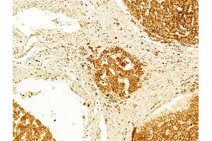 ABIN6262072 and ABIN6266555 at 1/100 staining Human normal tissues adjacent to liver cancer by IHC-P.