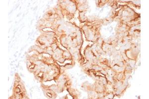 Formalin-fixed, paraffin-embedded human Ovarian Carcinoma stained with MUC16 Mouse Monoclonal Antibody (MUC16/1860). (MUC16 抗体)