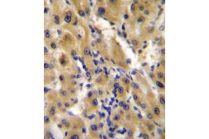 immunohistochemistry analysis in formalin fixed and paraffin embedded human hepatocarcinoma followed by peroxidase conjugation of the secondary antibody and DAB staining.