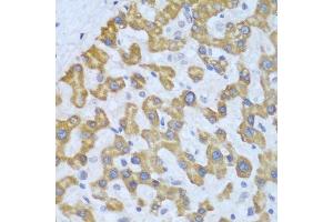Immunohistochemistry of paraffin-embedded human liver cancer using PRKCD antibody. (PKC delta 抗体  (AA 477-676))