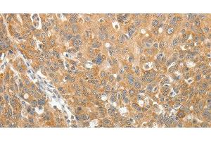 Immunohistochemistry of paraffin-embedded Human ovarian cancer using AKR1B1 Polyclonal Antibody at dilution of 1:30 (AKR1B1 抗体)