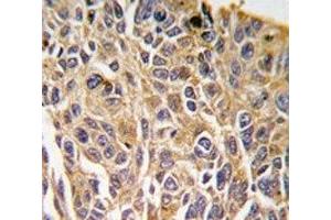 IHC analysis of FFPE human lung carcinoma tissue stained with RIPK3 antibody (RIPK3 抗体  (AA 1-30))