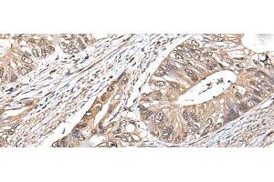 Immunohistochemistry of paraffin-embedded Human colorectal cancer tissue using ATF6B Polyclonal Antibody at dilution of 1:30(x200)