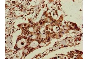 Immunohistochemistry of paraffin-embedded human pancreatic cancer using ABIN7151588 at dilution of 1:100