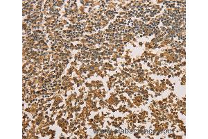 Immunohistochemistry of Human cervical cancer using SETD2 Polyclonal Antibody at dilution of 1:40 (SETD2 抗体)
