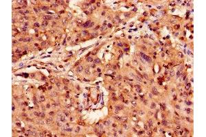 Immunohistochemistry of paraffin-embedded human lung cancer using ABIN7144485 at dilution of 1:100