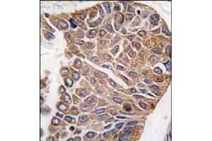 Formalin-fixed and paraffin-embedded human lung carcinoma tissue reacted with AKT2 antibody (C-term), which was peroxidase-conjugated to the secondary antibody, followed by DAB staining. (AKT2 抗体  (C-Term))