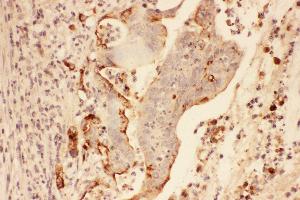 Anti-MMP7 Picoband antibody,  IHC(P): Human Intestinal Cancer Tissue (MMP7 抗体  (AA 1-267))