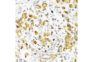 Immunohistochemistry of paraffin-embedded human gastric cancer using TAPBP Antibody (ABIN6132745, ABIN6148848, ABIN6148850 and ABIN6219122) at dilution of 1:200 (40x lens). (TAPBP 抗体  (AA 30-260))