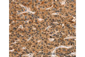 Immunohistochemistry of Human gastric cancer using KLRC1 Polyclonal Antibody at dilution of 1:30 (CD159a/c 抗体)