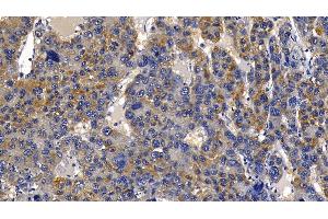 Detection of PGLYRP1 in Human Liver cancer Tissue using Polyclonal Antibody to Peptidoglycan Recognition Protein 1 (PGLYRP1)