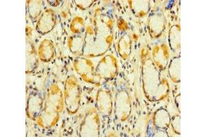 Immunohistochemistry of paraffin-embedded human gastric cancer using ABIN7175053 at dilution of 1:100 (KIAA1324-Like 抗体  (AA 227-526))