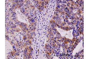 Immunoperoxidase of monoclonal antibody to TYMS on formalin-fixed paraffin-embedded human stomach carcinoma. (TYMS 抗体  (AA 111-210))