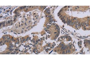 Immunohistochemistry of paraffin-embedded Human colon cancer tissue using CCL1 Polyclonal Antibody at dilution 1:50 (CCL1 抗体)