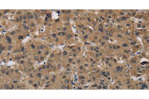 Immunohistochemistry of paraffin-embedded Human liver cancer using FABP2 Polyclonal Antibody at dilution of 1:40 (FABP2 抗体)