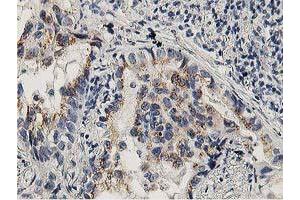Immunohistochemical staining of paraffin-embedded Carcinoma of Human lung tissue using anti-LACTB2 mouse monoclonal antibody. (LACTB2 抗体)
