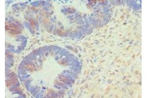 Immunohistochemistry of paraffin-embedded human ovarian cancer using ABIN7145167 at dilution of 1:100 (Cyclin D1 抗体  (AA 1-233))