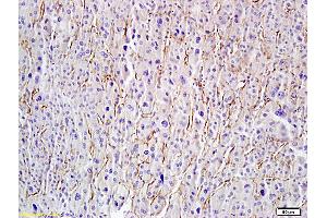 Formalin-fixed and paraffin embedded human hepatoma labeled with Anti-Hyaluronidase-PH20/Haase Polyclonal Antibody, Unconjugated (ABIN673779) followed by conjugation to the secondary antibody and DAB staining (HYAL1 抗体  (AA 271-400))