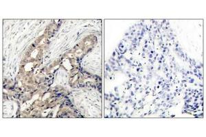 Immunohistochemical analysis of paraffin-embedded human breast carcinoma tissue using c-Abl (phospho-Tyr412) antibody.