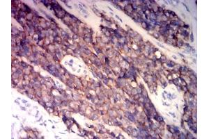Immunohistochemical analysis of paraffin-embedded ewing sarcoma tissues using CD99 mouse mAb with DAB staining. (CD99 抗体  (AA 1-185))