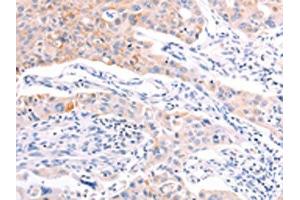 The image on the left is immunohistochemistry of paraffin-embedded Human lung cancer tissue using ABIN7192139(RalA Antibody) at dilution 1/20, on the right is treated with synthetic peptide. (rala 抗体)