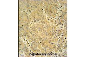 CYP2A7 antibody immunohistochemistry analysis in formalin fixed and paraffin embedded human hepatocarcinoma followed by peroxidase conjugation of the secondary antibody and DAB staining.