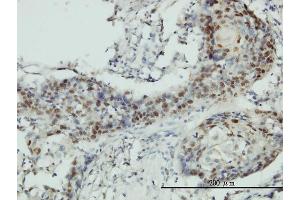 Immunoperoxidase of monoclonal antibody to RNMT on formalin-fixed paraffin-embedded human squamous cell carcinoma tissue. (RNMT 抗体  (AA 1-476))