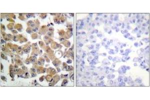 Immunohistochemistry analysis of paraffin-embedded human breast carcinoma tissue, using TGF beta1 Antibody. (TGFB1 抗体  (AA 336-385))