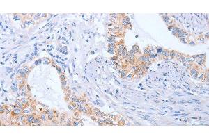 Immunohistochemistry of paraffin-embedded Human cervical cancer tissue using BST1 Polyclonal Antibody at dilution 1:50 (BST1 抗体)